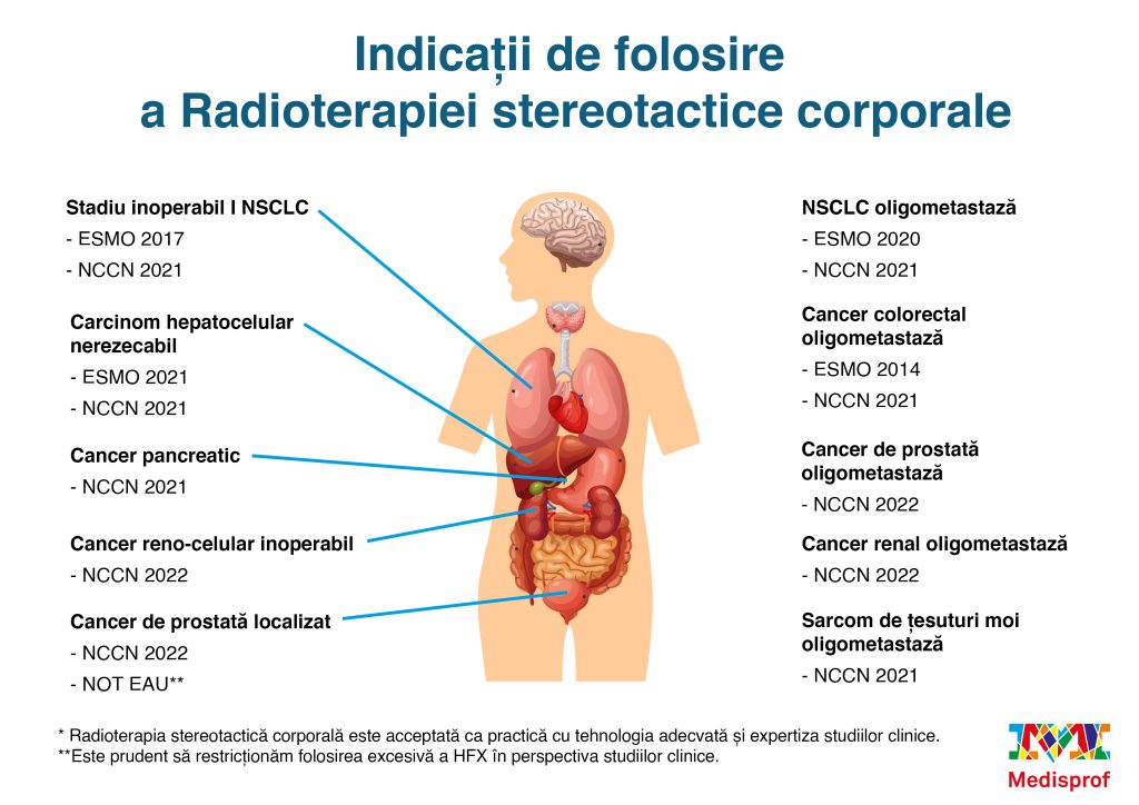 radiochirurgie stereotactica